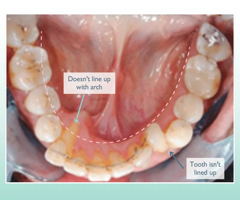 Top view image of lower teeth showing teeth not lining up