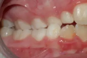 Posterior crossbite requiring treatment with a palatal expander