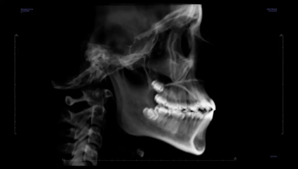Xray of teeth