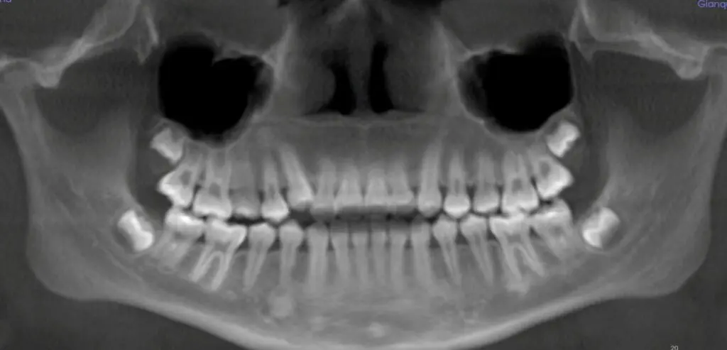 Xray of teeth