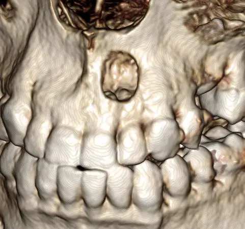 3D scan of teeth
