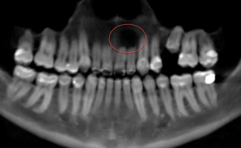Xray of teeth