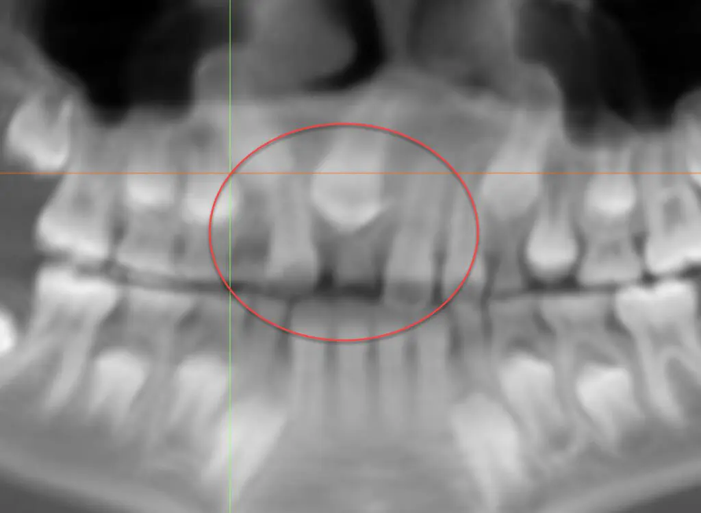 X ray of teeth