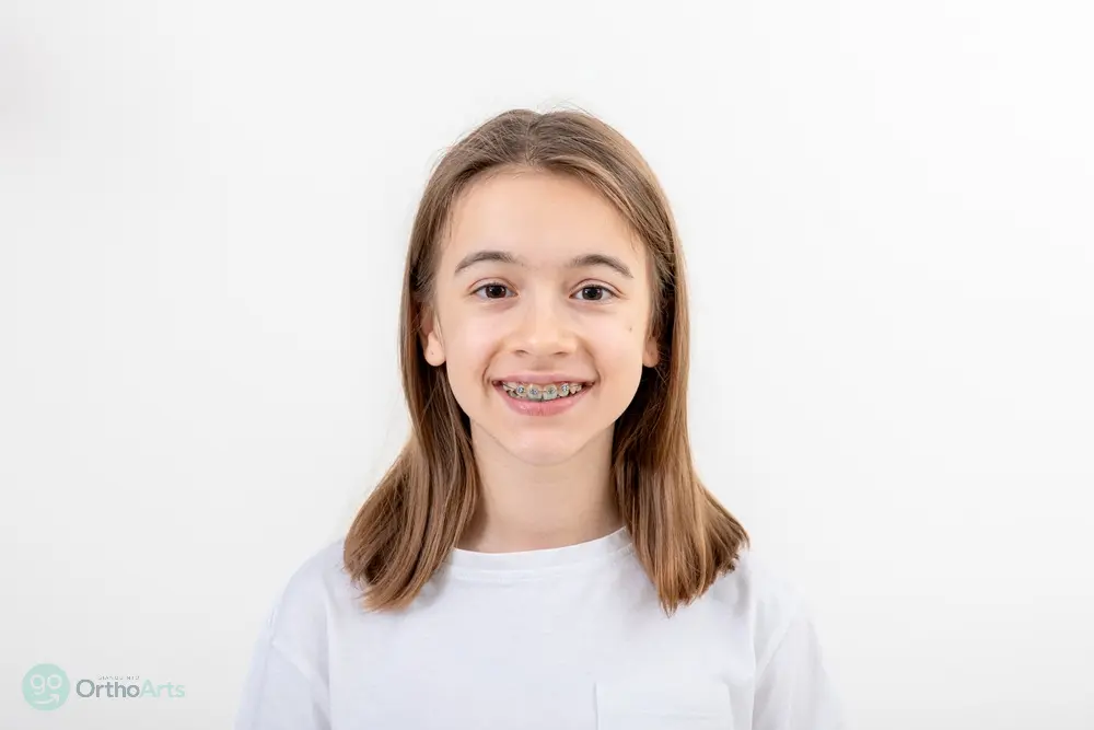 Smiling teenage girl with braces for overbite in bakersfield and tehachapi, ca, showcasing progress in orthodontic treatment.