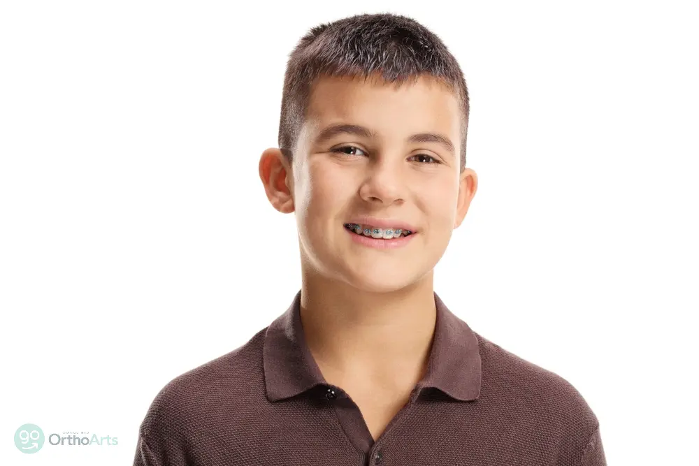 Smiling teenage boy with braces for overbite in bakersfield and tehachapi, ca, showcasing progress in orthodontic treatment.