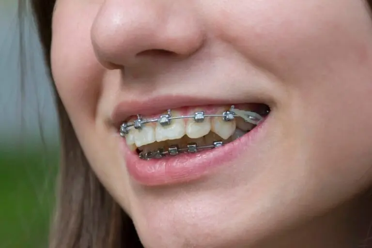Close-up of a smiling patient showing metal braces on teeth – braces for overbite in bakersfield and tehachapi,ca.