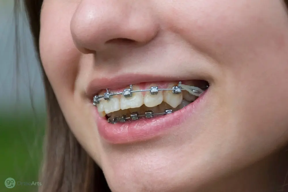 smiling girl metal braces her teeth - Overbite vs Underbite in Bakersfield and Tehachapi, CA.