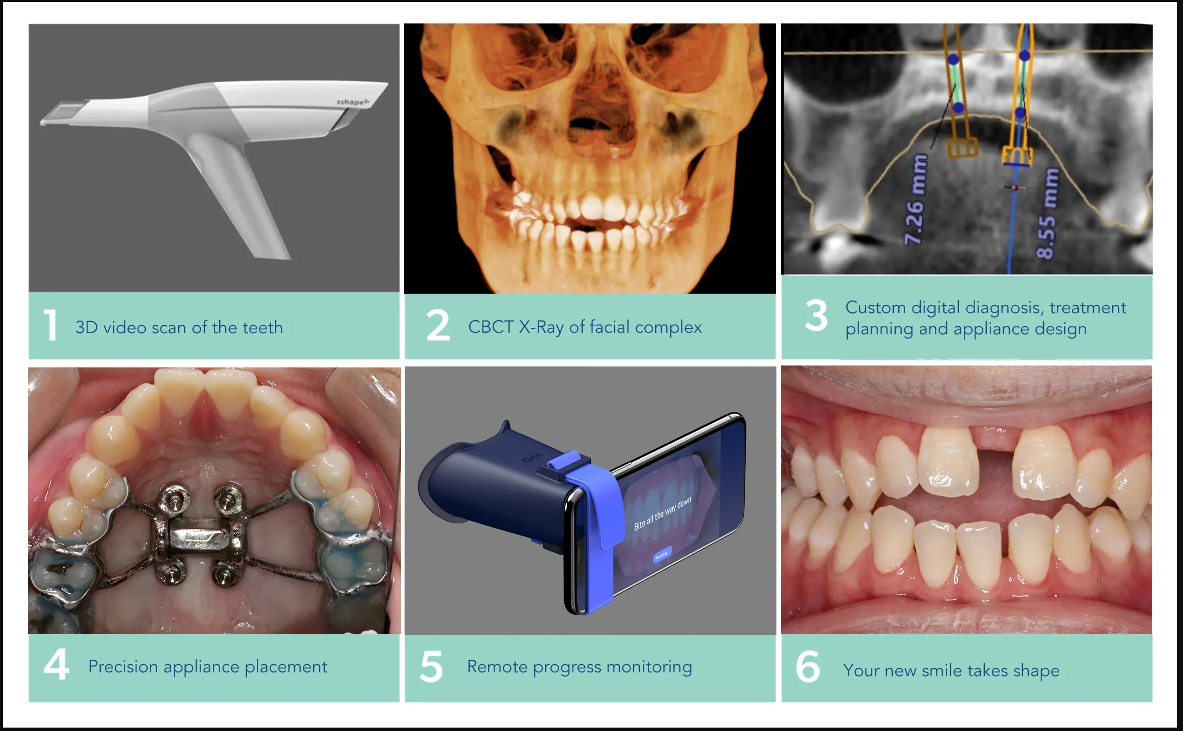 Process of MARPE design and placement for maxillary skeletal expansion at Gianquinto Orthodontic Arts in
Bakersfield, Tehachapi or Mammoth Lakes, CA