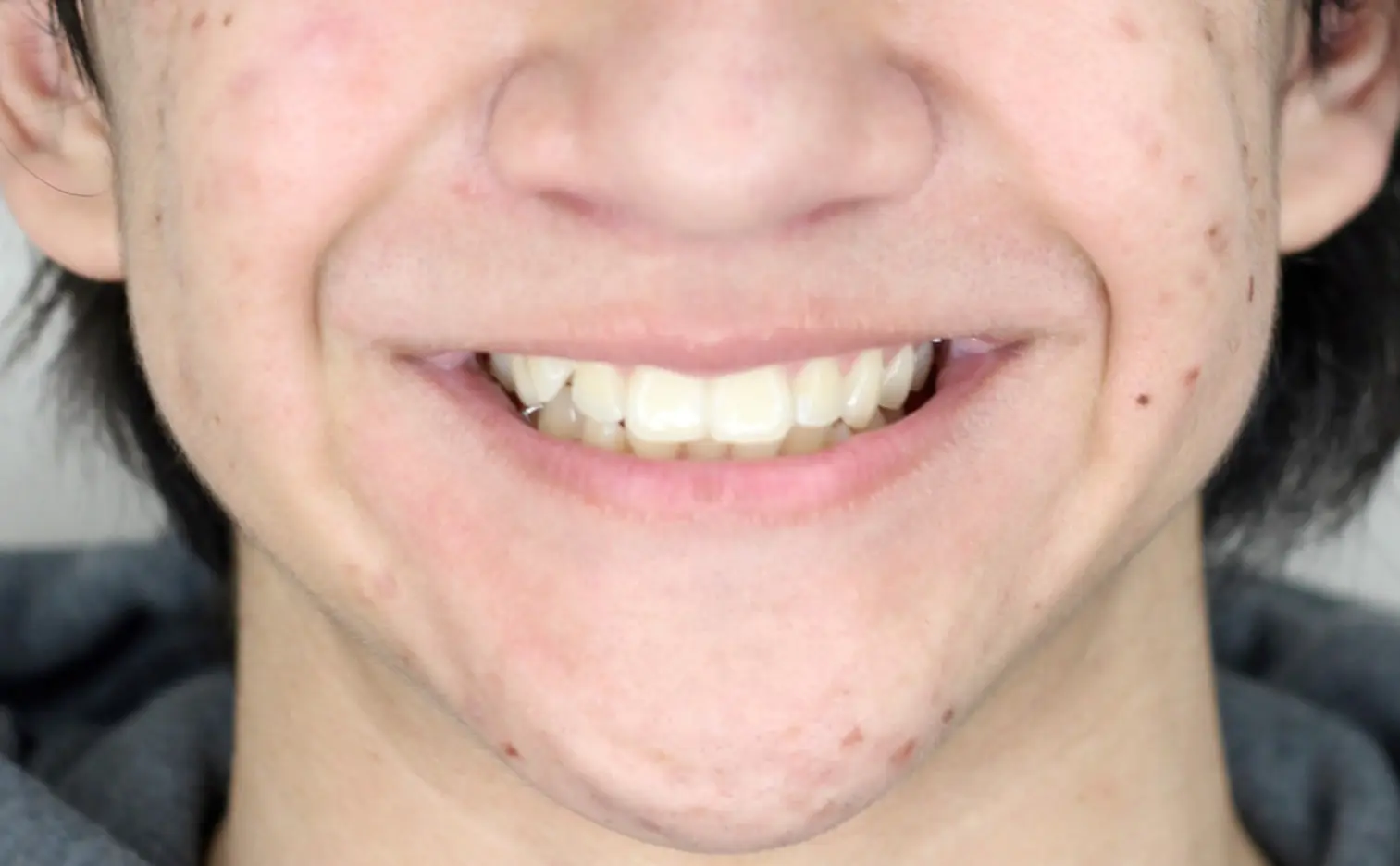 A smiling mouth shows teeth before braces and visible acne, with Gianquinto Orthodontic Arts in Mammoth Lakes, CA.