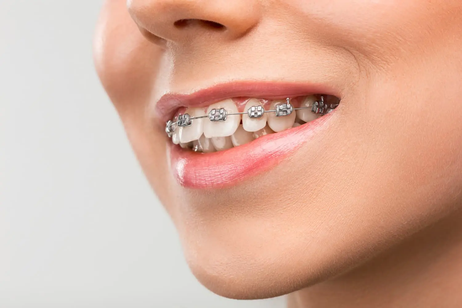 A smiling person with metal dental braces, as seen at Gianquinto Orthodontic Arts in Bakersfield, Tehachapi and Mammoth Lakes WA, for overbite correction.