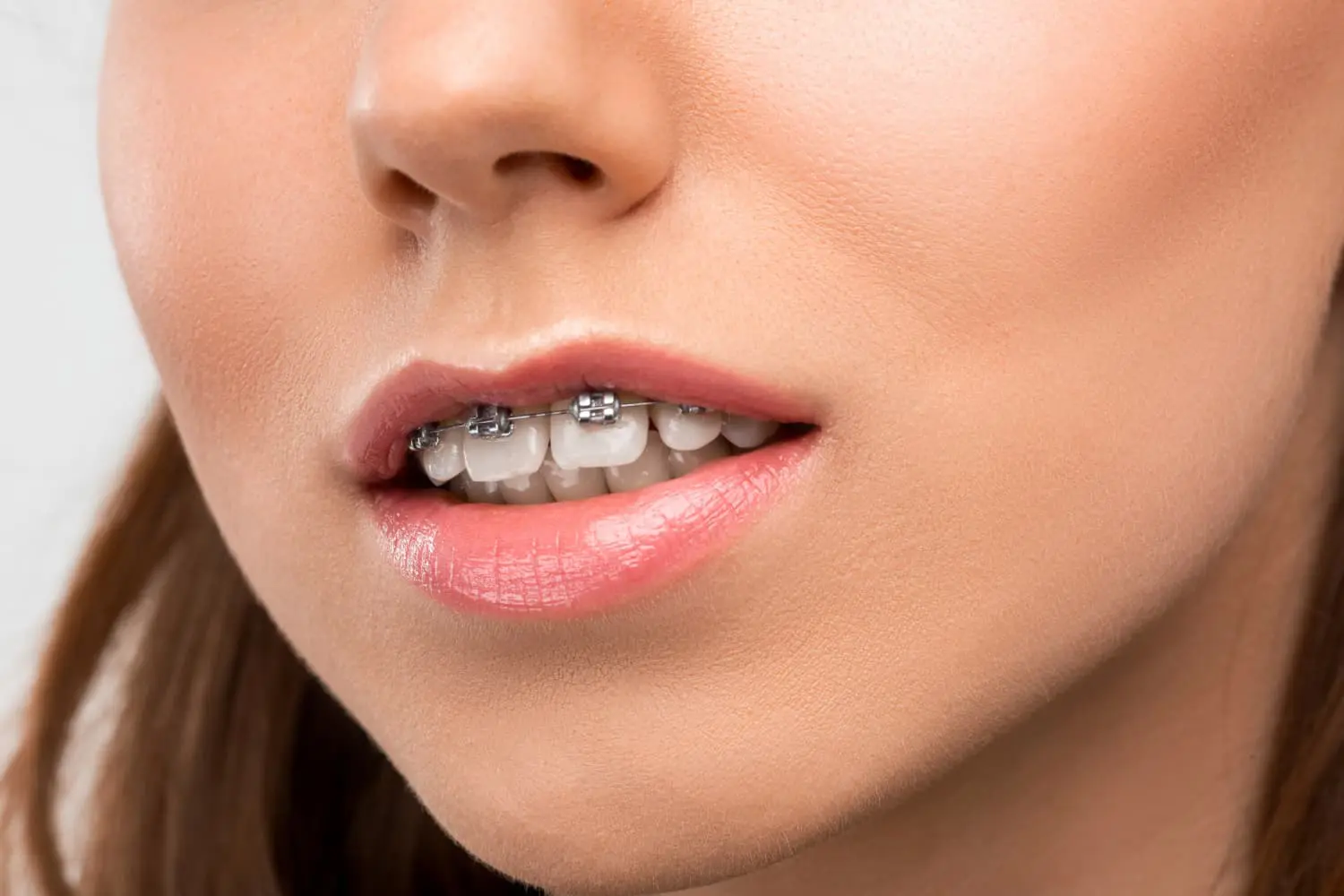 A person's lower face with metal braces correcting an overbite, at Gianquinto Orthodontic Arts in Bakersfield, Tehachapi and Mammoth Lakes, CA.
