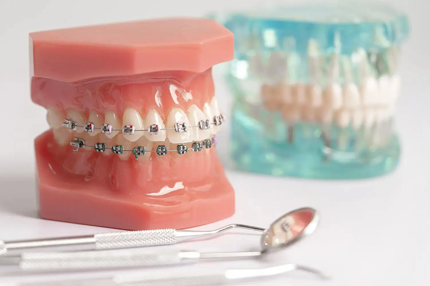 Dental models, one with metal braces and one without at Gianquinto Orthodontic Arts in Bakersfield, Tehachapi and Mammoth Lakes, CA.