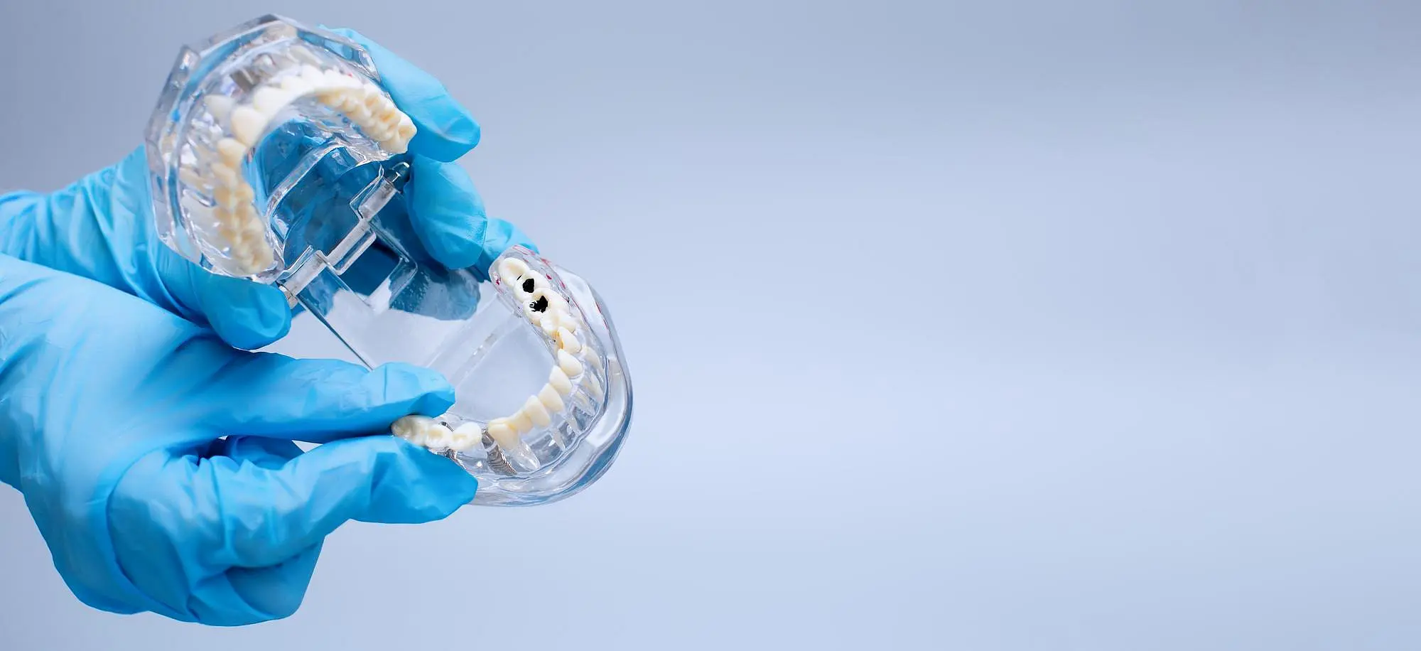 A gloved hand holds a dental model showing the use of a MARPE Appliance and cavity, offered by Gianquinto Orthodontic Arts in Bakersfield, Tehachapi or Mammoth Lakes, CA