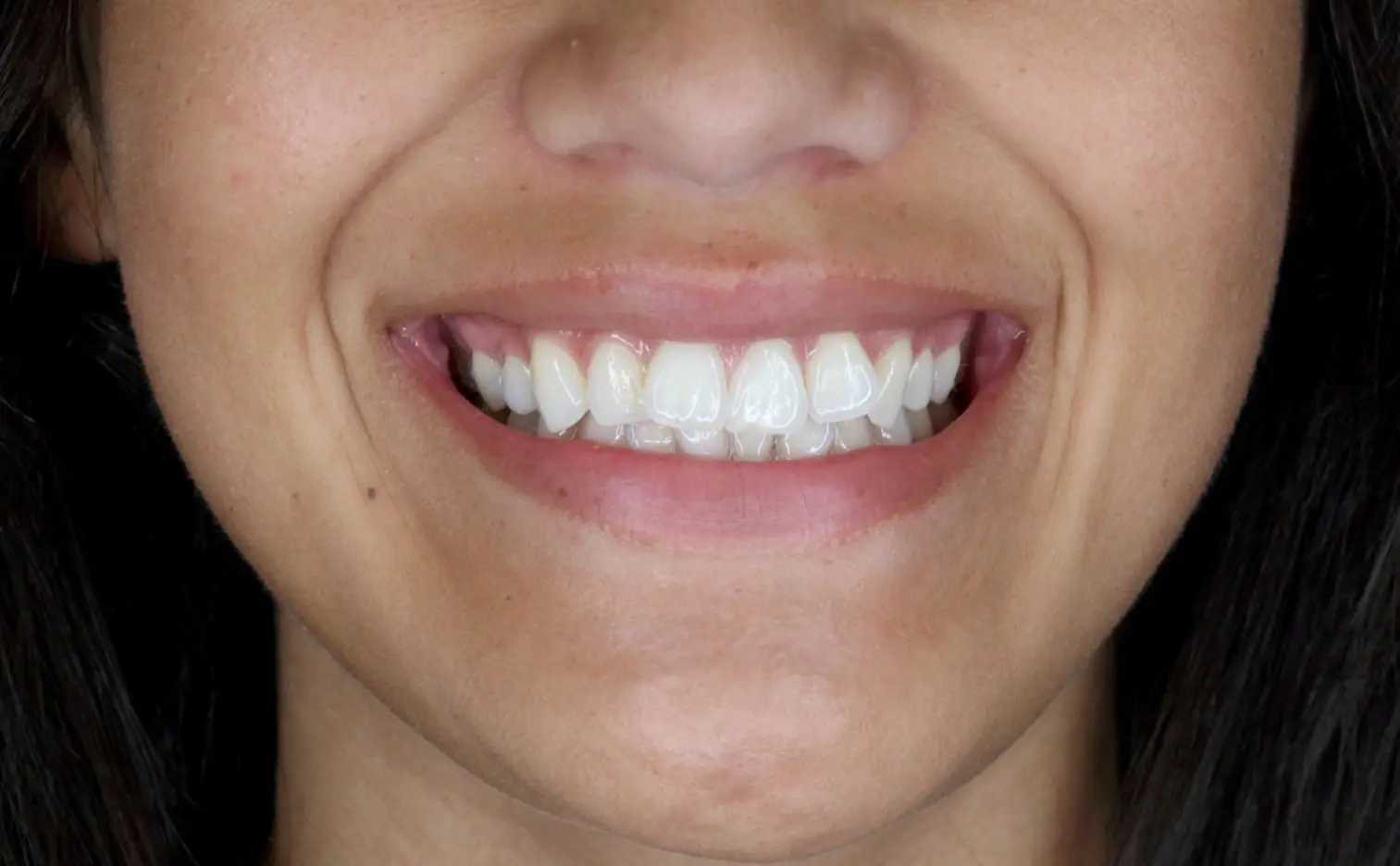 A close-up of a smile with misaligned teeth and visible gums before braces at Gianquinto Orthodontic Arts in Tehachapi, CA.