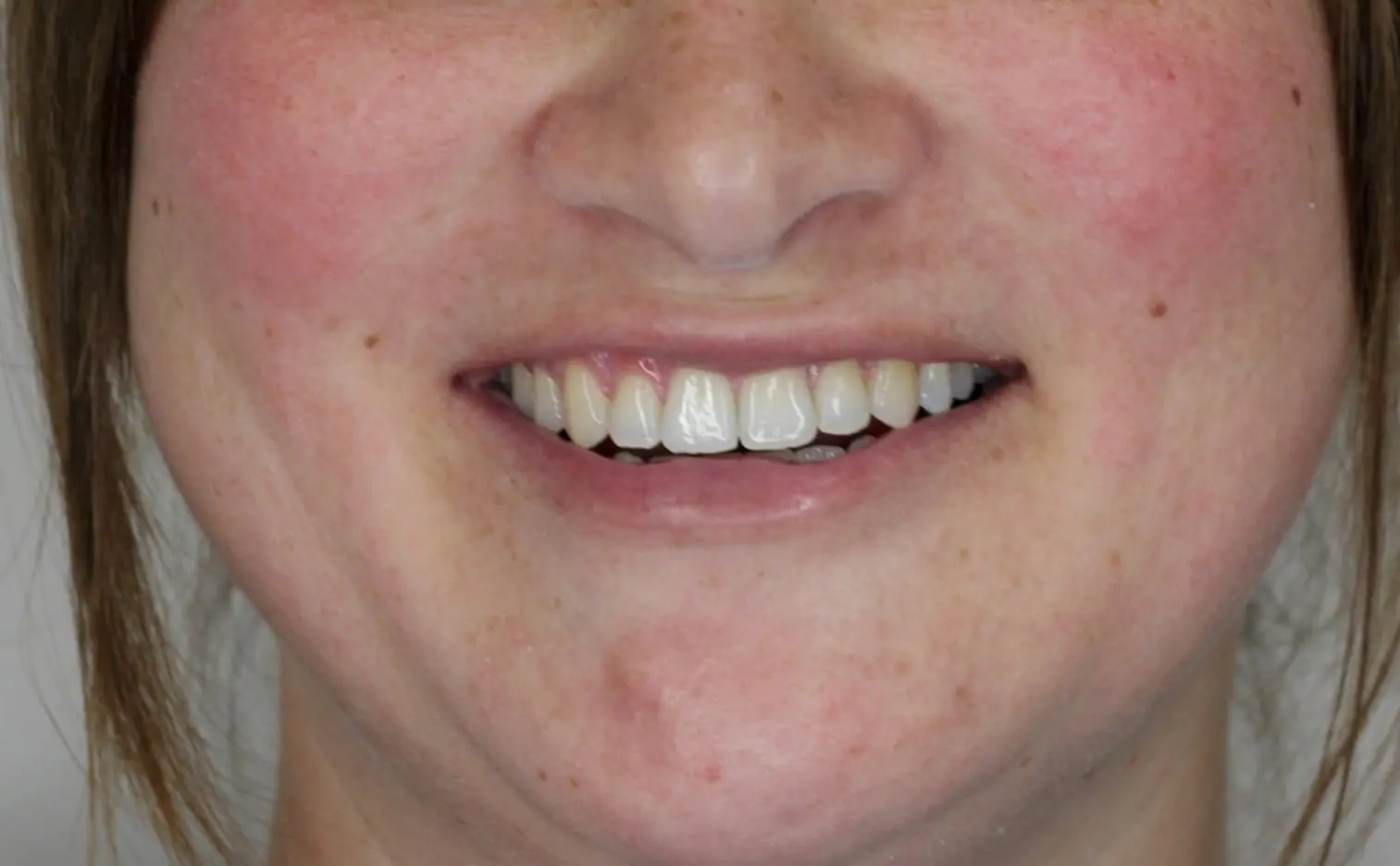 A close-up shows a post-Invisalign smile with slightly uneven teeth and cheek redness at Gianquinto Orthodontic Arts in Mammoth Lakes, CA.