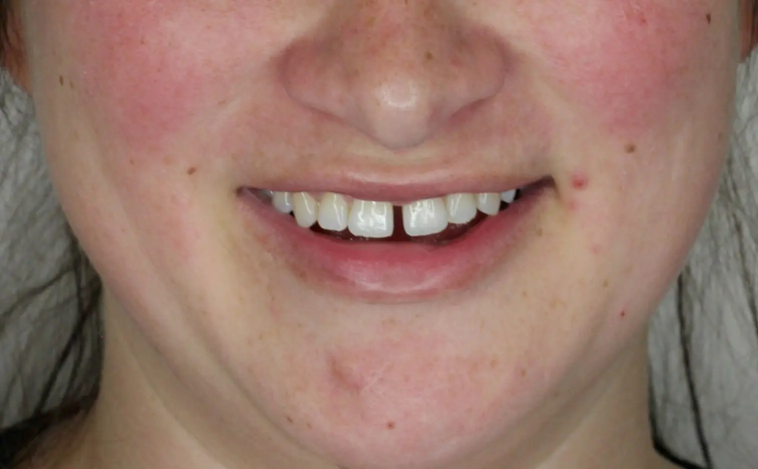 Smiling person before Invisalign at Gianquinto Orthodontic Arts in Mammoth Lakes, CA; small tooth gap visible.