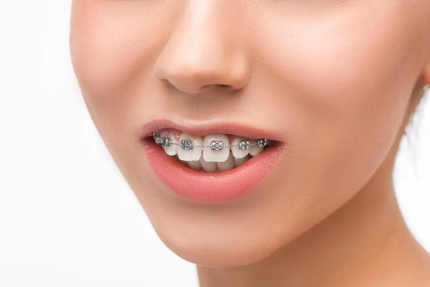 woman with braces show causes of severe overjet and overbite at Gianquinto Orthodontic Arts in Bakersfield, Tehachapi or Mammoth Lakes, CA
