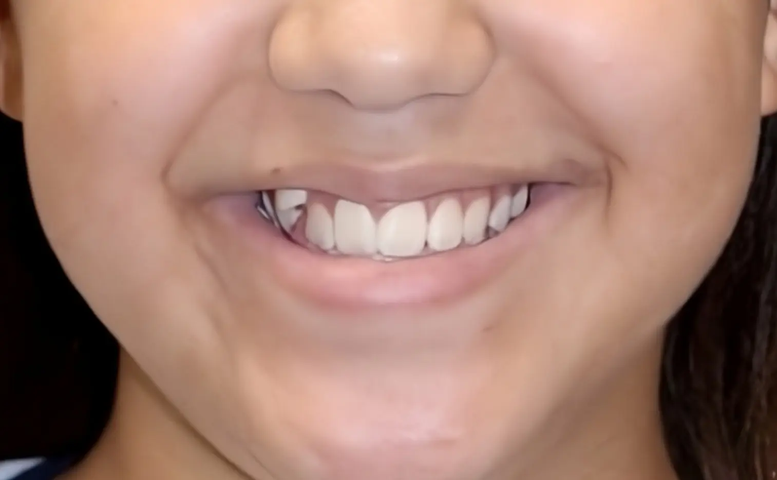 Before Treatment Braces at Gianquinto Orthodontic Arts in Bakersfield, CA