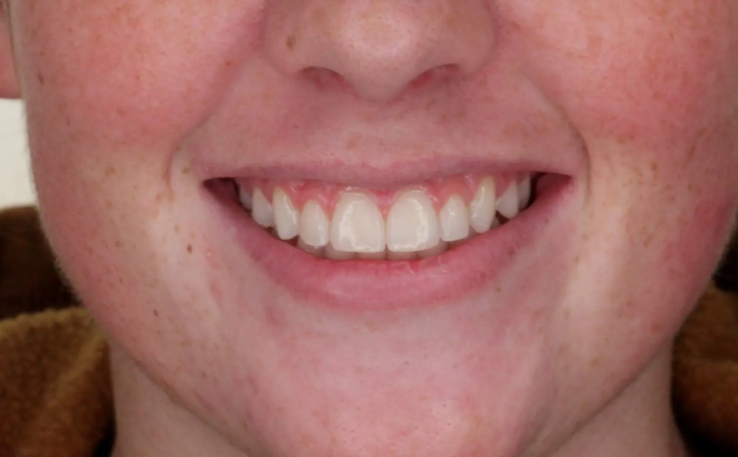 A bright smile with straight teeth after braces at Gianquinto Orthodontic Arts in Bakersfield, Tehachapi or Mammoth Lakes, CA.