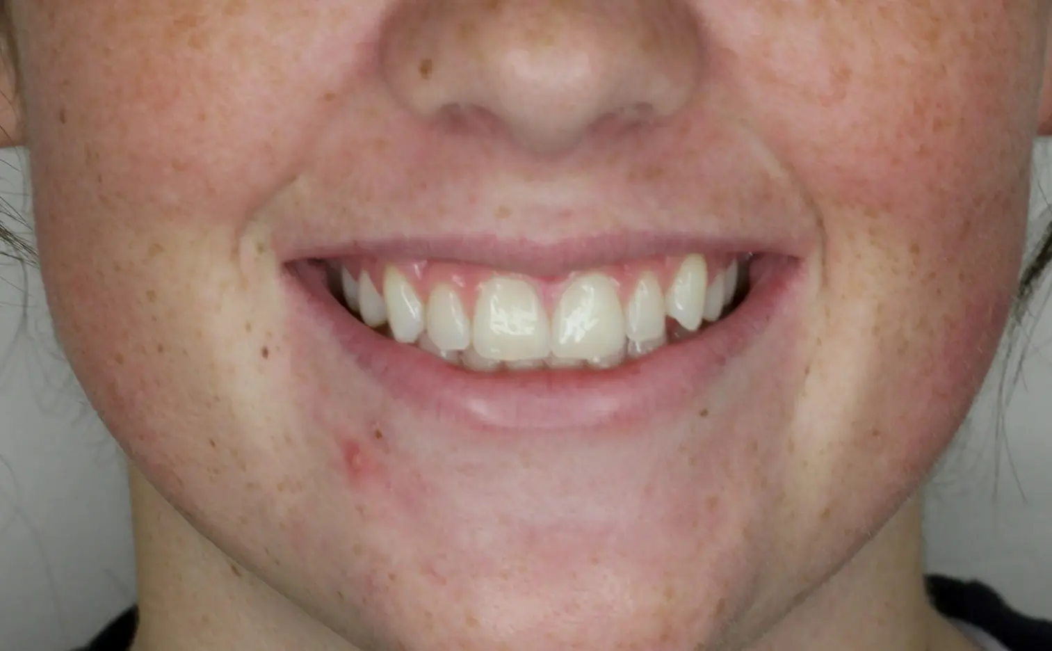 A person smiles before braces at Gianquinto Orthodontic Arts in Bakersfield, Tehachapi or Mammoth Lakes, CA, with straight teeth, freckles, and mild skin redness.