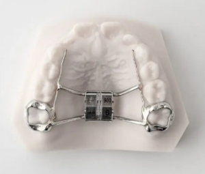 3D printed automatic palatal expander by orthodontist Dr. Jared Gianquinto in Bakersfield CA