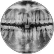 Panoramic x-ray - essential for surgical orthodontics and adult braces in bakersfield ca