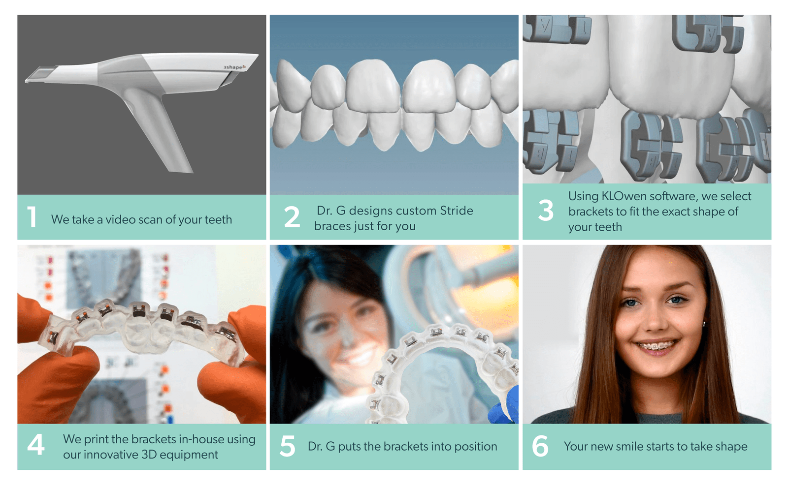 1. We take a video scan of your teeth 2. Dr. G designs custom Stride braces just for you 3. Using KLOwen software, we select brackets to fit the exact shape of your teeth 4. We print the brackets in-house using our innovative 3D equipment 5. Dr. G puts the brackets into position 6. Your new smile starts to take shape