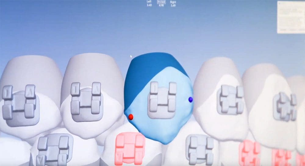 3D imaging software showing braces cost in bakersfield ca