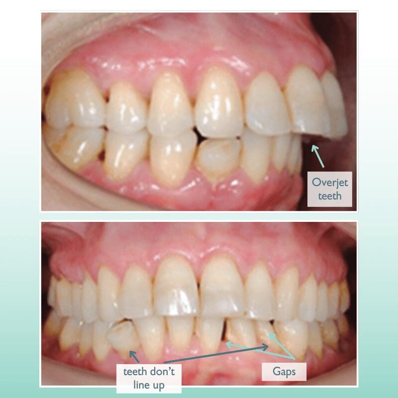 Image of teeth showing an overjet of upper teeth, teeth not lining up, and gaps between teeth caused by permanent retainers in Bakersfield