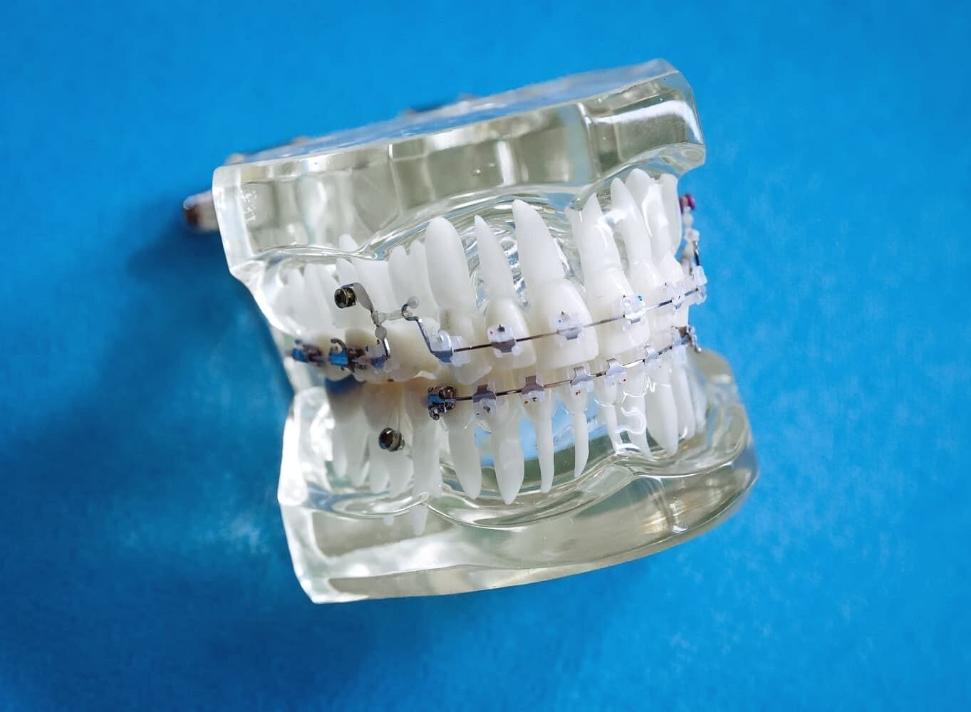 A clear dental model with metal braces is shown on a blue surface at Gianquinto Orthodontic Arts in Bakersfield, Tehachapi and Mammoth Lakes, CA.