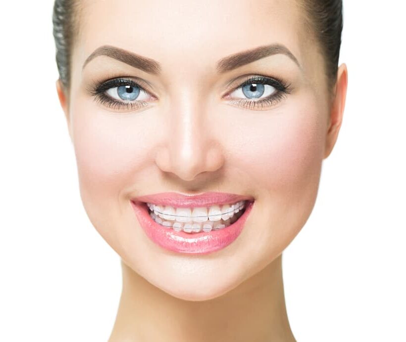 Smiling person with blue eyes wearing Clear Braces, featured by Gianquinto Orthodontic Arts in Bakersfield, Tehachapi and Mammoth Lakes, CA.