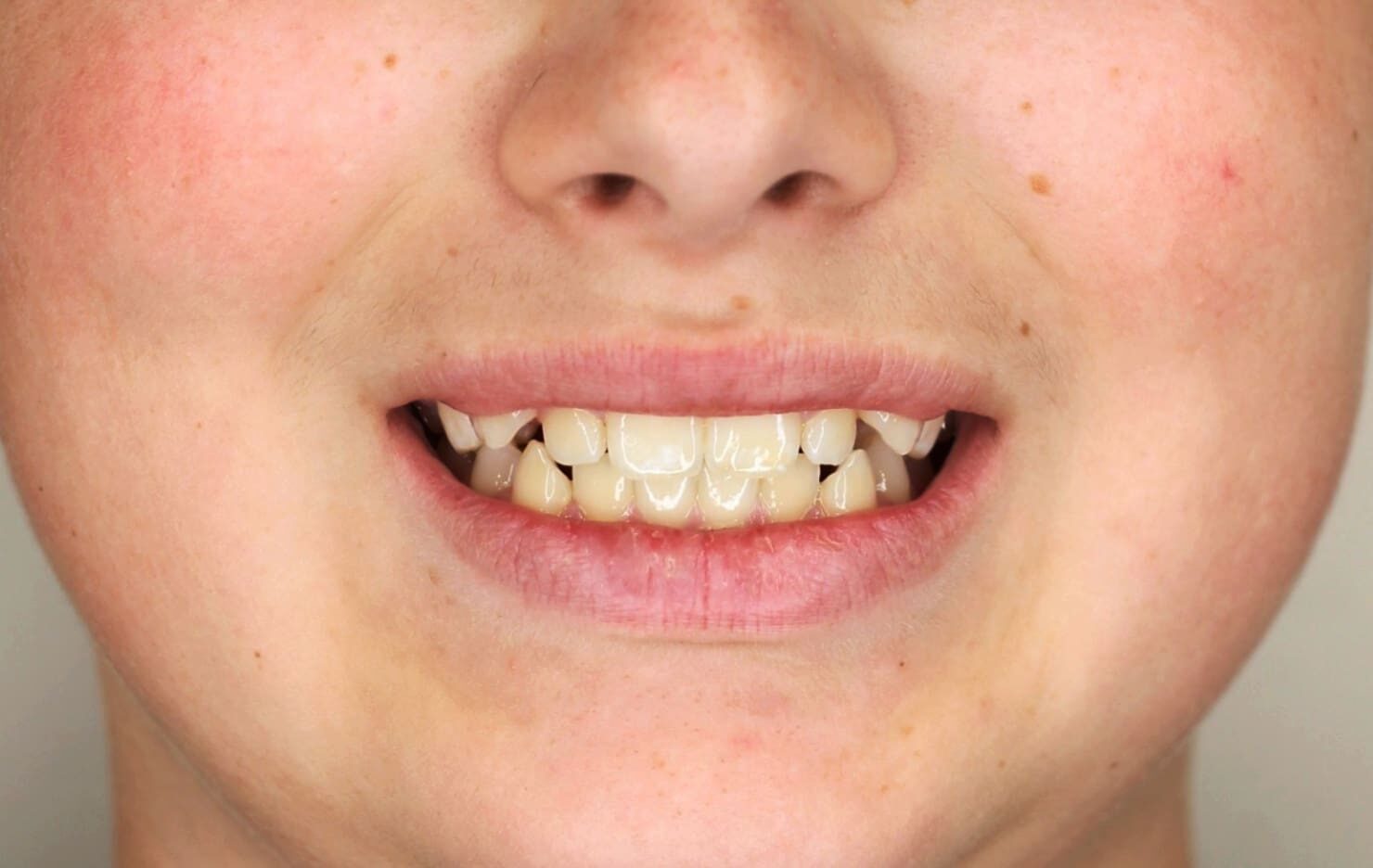 Before Treatment Braces at Gianquinto Orthodontic Arts in Bakersfield, CA
